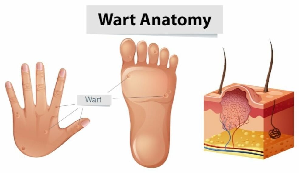 Successfully remove warts and roots using Removio