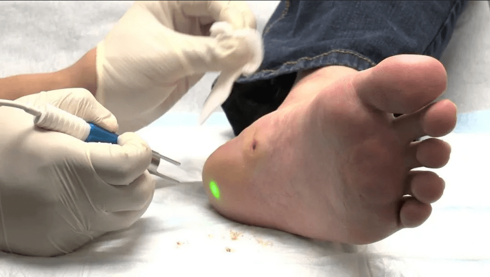 Treatment of sole warts