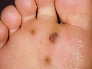 How to get rid of sole warts