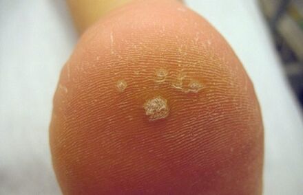 How to identify Pierce warts