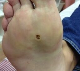 How to remove leg soles