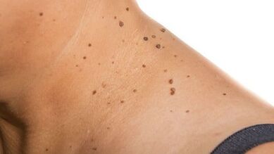 How to get rid of papillomas around your neck