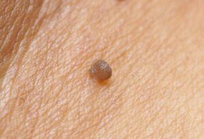 Clinical pictures of papilloma