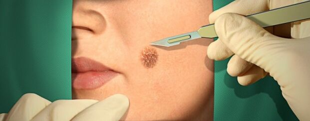 Surgery treatment of papilloma
