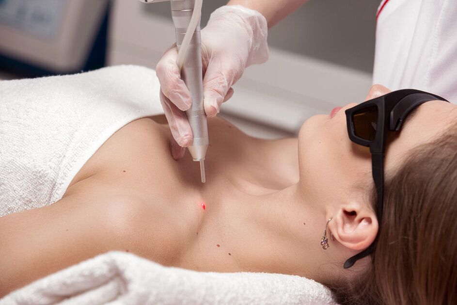 Laser removal of papilloma