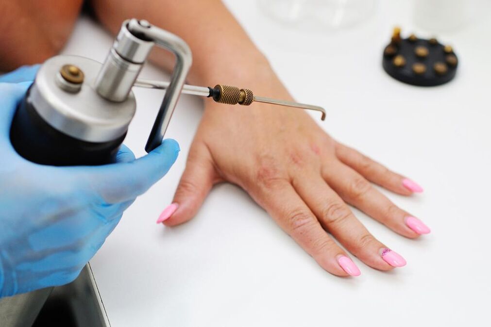 Remove papillary-like with liquid nitrogen