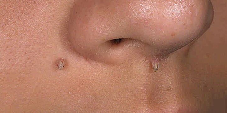 Causes of papilloma
