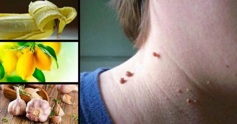 What is papilloma