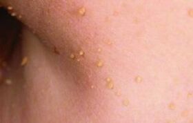 Causes of papillomas on the body