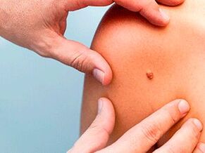 Causes of Papillomas in the Body