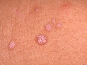 How to remove papillomas from the body