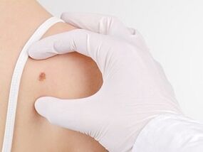What are the dangers of having papillomas on the body