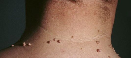 How to get rid of papilloma