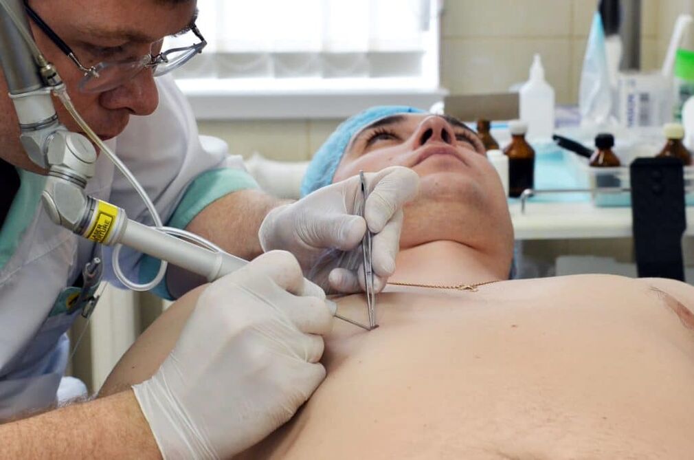 How to remove warts from body