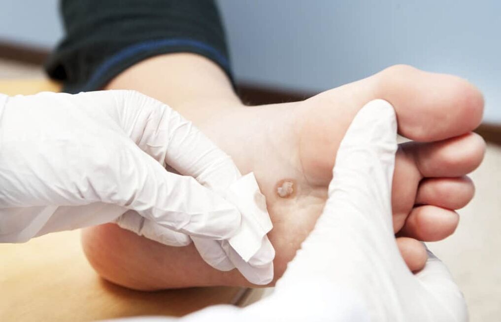 Why do warts appear on the body