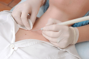 How to remove papillomas