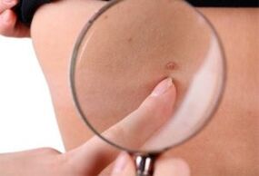 Main causes of papilloma