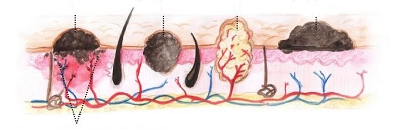 Types of human papillomas