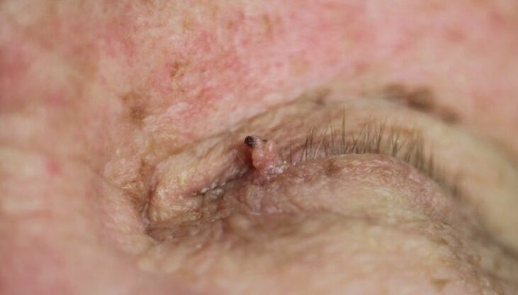 How to remove papillomas on eyelids