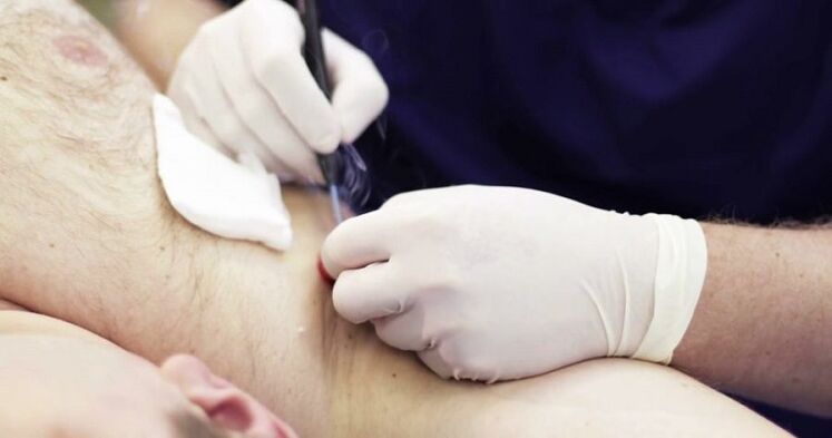 Professional way to remove human papillomas