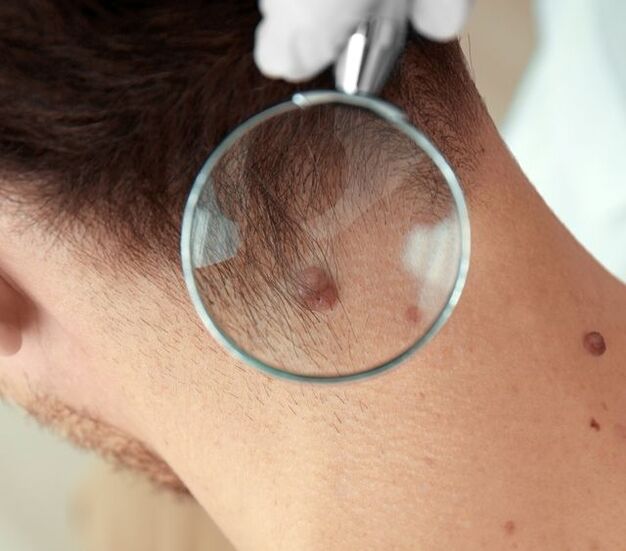Doctor examines cervical papilloma