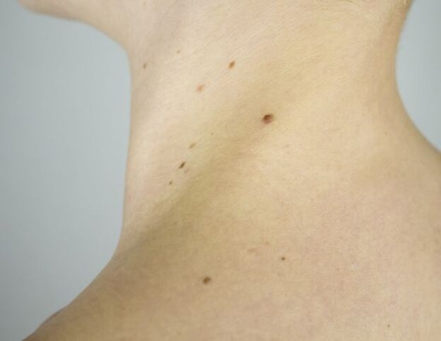 Papilloma on girl's neck