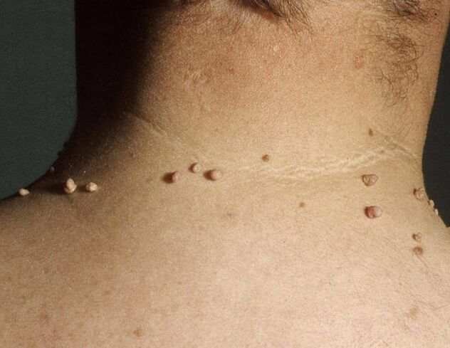 Papilloma on man’s neck