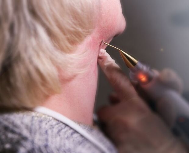 The process of removing cervical papillomas in women