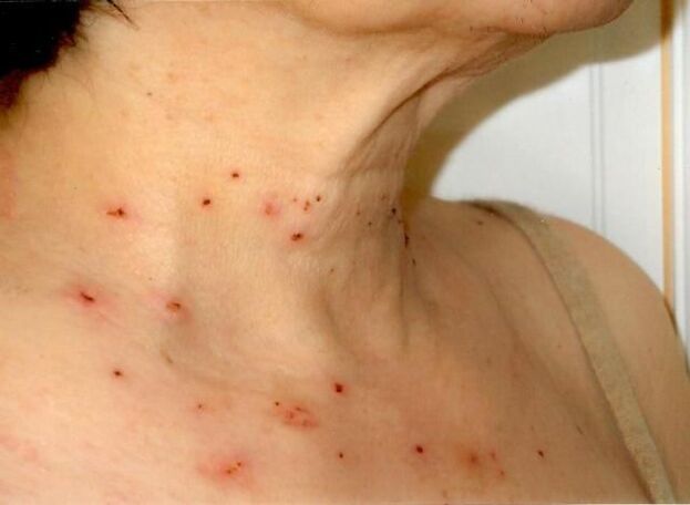 Treatment results for cervical papillomas