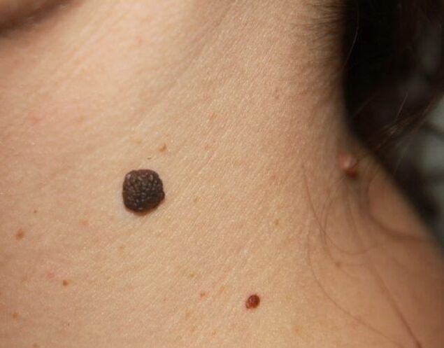 cervical flat papilloma