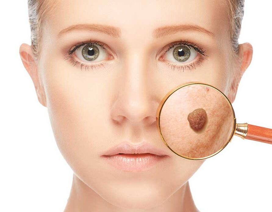 papilloma on face