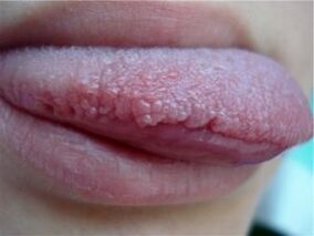 papilloma on tongue