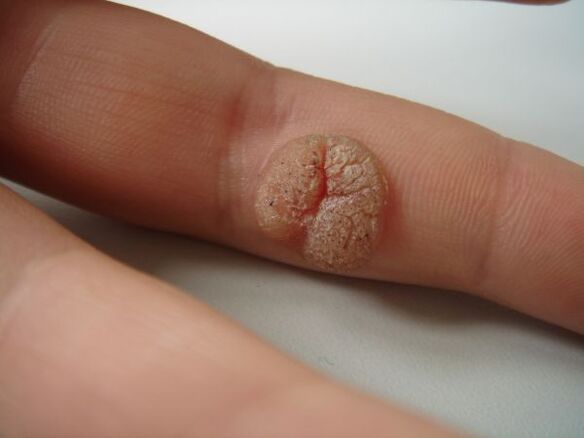 Complications of spontaneous papilloma removal