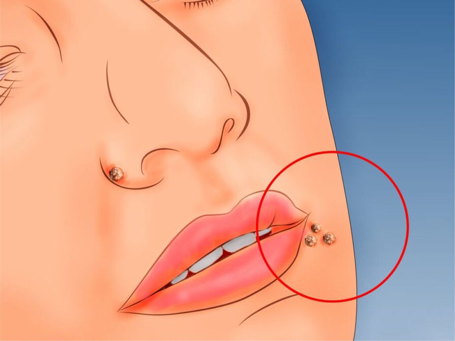 papilloma on face