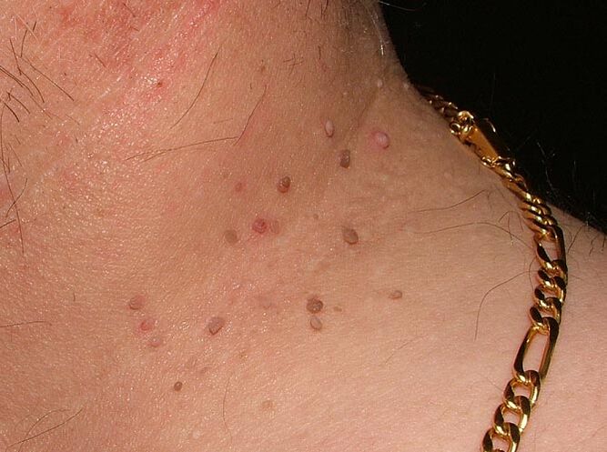 papillomas on neck
