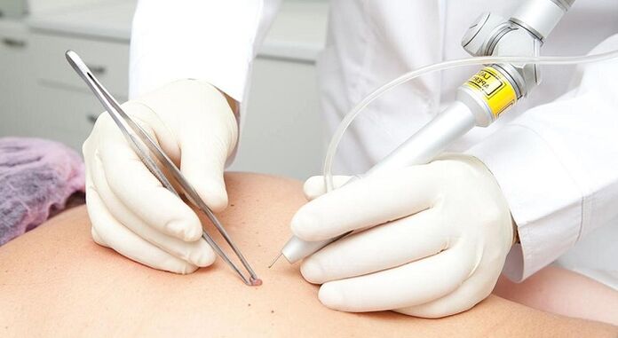 Laser removal of papillomavirus