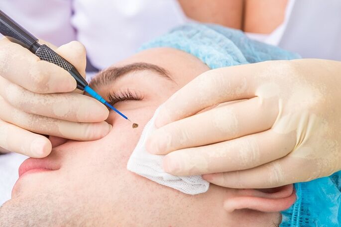 Removal of Facial Papillomas Caused by Human Papilloma Virus