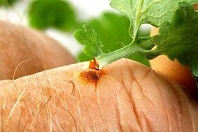 Celandine herb juice to remove papilloma