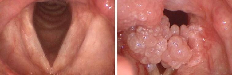 Clear throat and pharyngeal papilloma