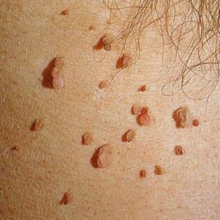 Papillomas usually grow in clusters and can appear on the skin all over the body