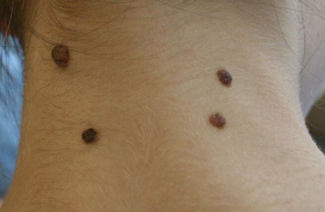 numerous moles